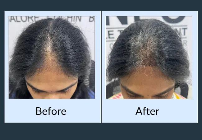 Female patient hair density improvement after PRP and GFC therapy