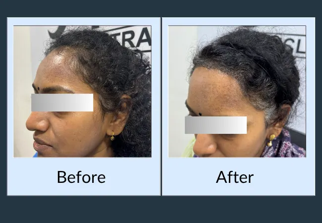 Female pattern hair loss density improvement after treatment