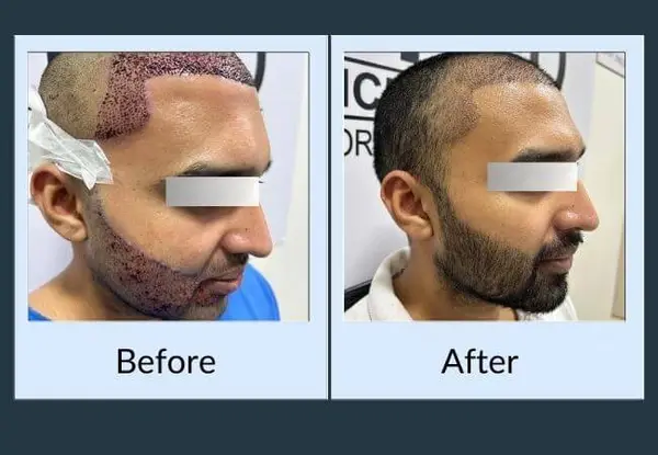 Beard transplant: the scalp donor area during the procedure, then the grown-in beard the transplanted hair produced.