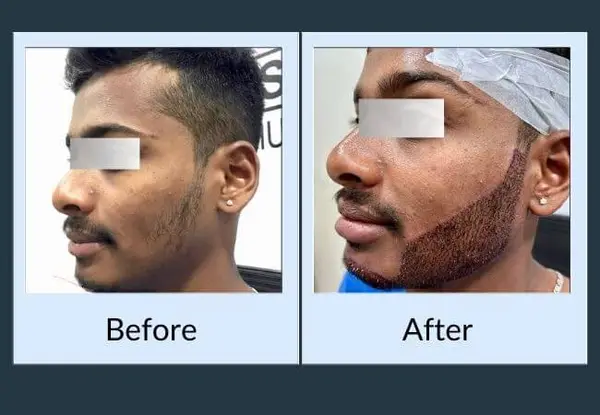 Beard transplant: a sparse moustache and jawline before the procedure, then the same area immediately afterwards with grafts newly placed.