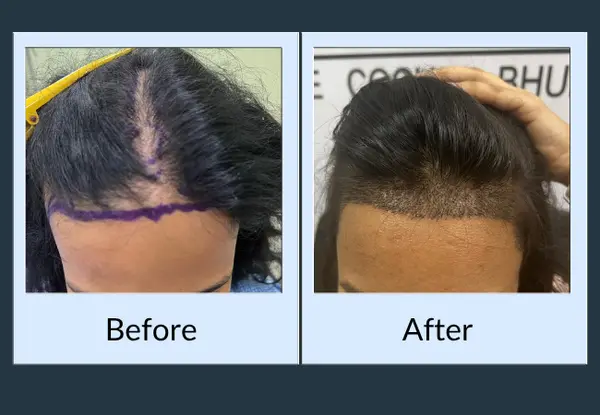 Female hair restoration: the planned hairline drawn onto a receded frontal scalp, then the restored hairline following that design.