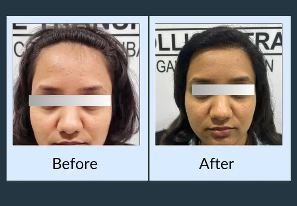 Female hair restoration before and after, front view: a high, thin frontal hairline, then a lowered hairline with fuller density.