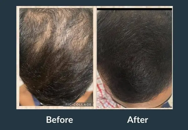GFC therapy before and after: diffuse thinning across the top of the scalp, then denser, darker coverage over the same area.