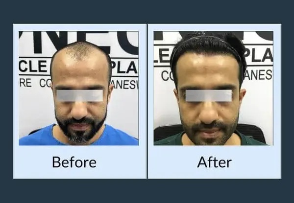 Hair transplant before and after: a deeply receding hairline and thinning mid-scalp, then a rebuilt hairline with even density across the front.