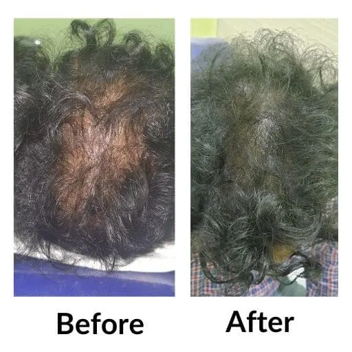 Before and after over the crown: scattered bare areas through the hair, then denser, more even coverage.