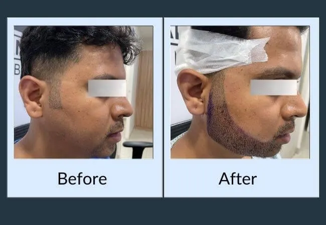 Before and after beard density restoration at Neo Follicle.