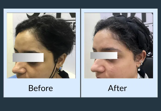 Before and after female hair restoration at Neo Follicle.