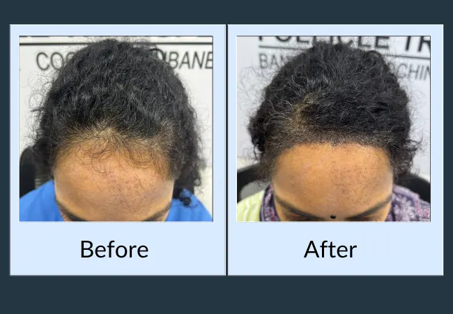 Before and after part-line density restoration at Neo Follicle.