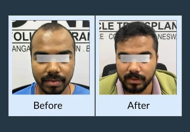 Before and after frontal density restoration in a male patient.
