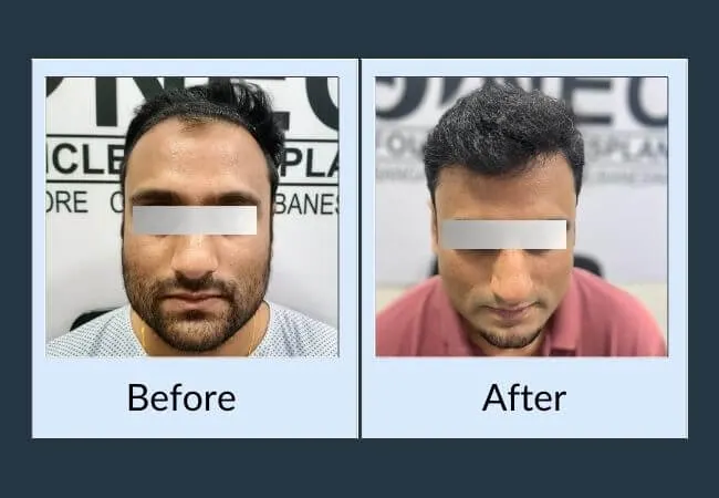 Before and after crown restoration in a male patient.